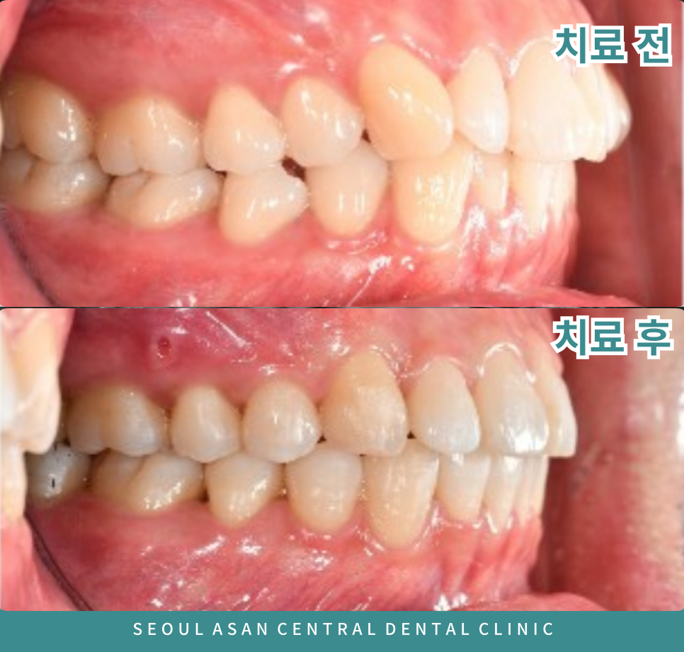 네번째 교정치료 전,후