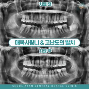 매복사랑니 고난도발치 대표이미지