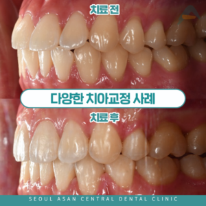 다양한 치아교정 사례
