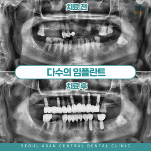 다수의 임플란트 대표이미지