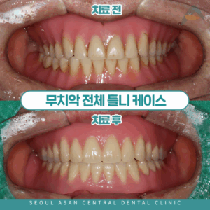 무치악 전체 틀니 대표이미지