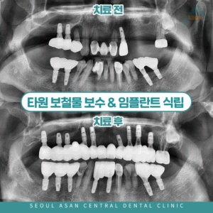 타원 보철물 보수 임플란트식립 대표이미지