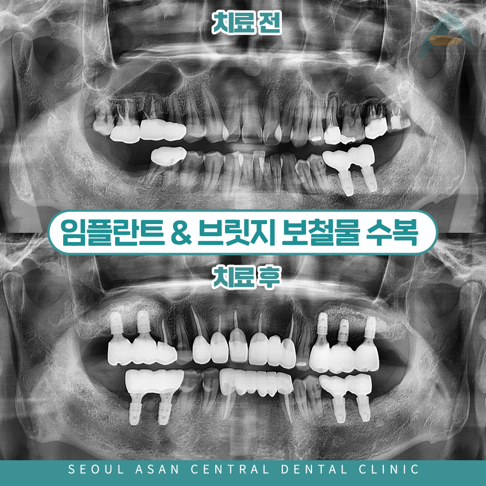 성남치과 임플란트 치아교정 전후 사례