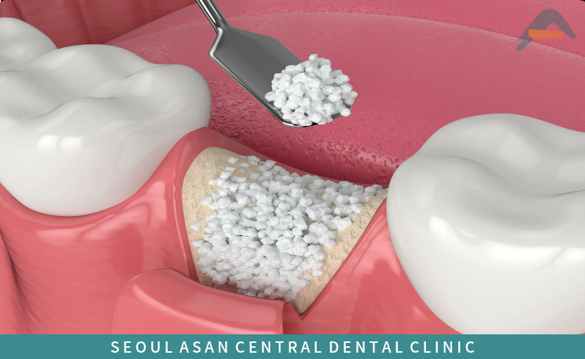 뼈이식을 진행하고 있는 이미지