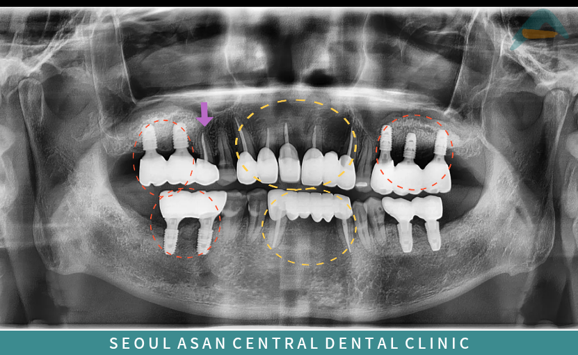 성남치과 임플란트와 브릿지 수복 : 치아 결손 해결