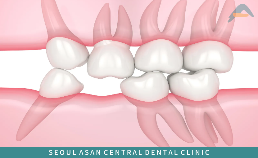 치아 상실로 인해 치아 교합이 무너진 사진