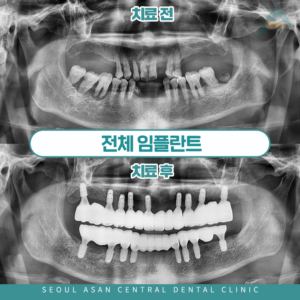 단대오거리치과 전체 임플란트 전후