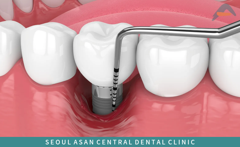 임플란트 후 관리가 이루어지지 않으면 생기는 임플란트 주위염