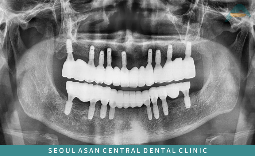 안정적으로 식립된 단대오거리치과 서울아산센트럴 전체 임플란트