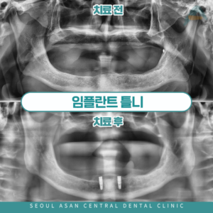 성남치과 임플란트 틀니 치료 전후