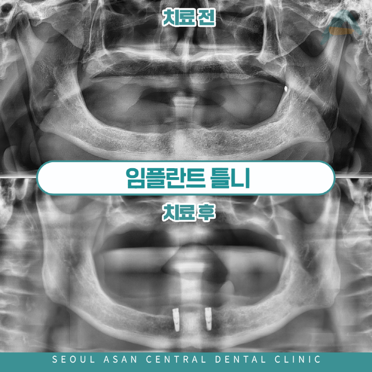 다수의 임플란트 식립이 어려운 상황에는 성남치과 서울아산센트럴에서는 임플란트 틀니를 사용한다.
