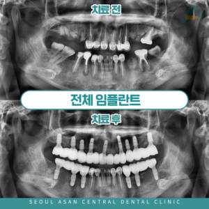 성남치과 전체임플란트 치료 전후