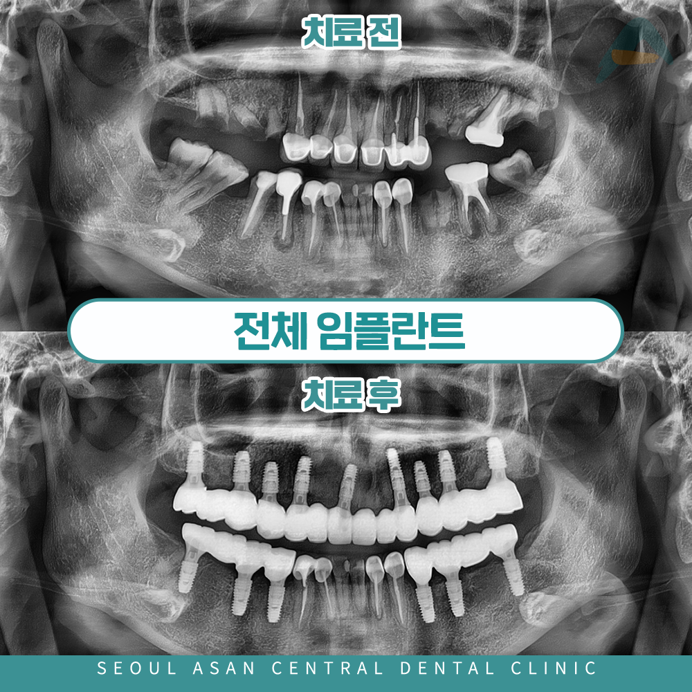 성남치과 전체임플란트 치료 전후 파노라마 사진
