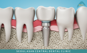 성남치과 임플란트