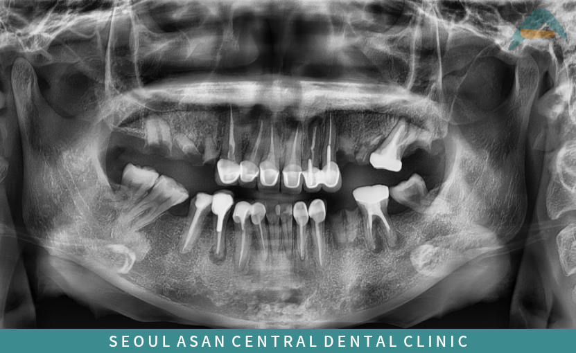 성남치과 전체 임플란트 치료 전 파노라마 사진