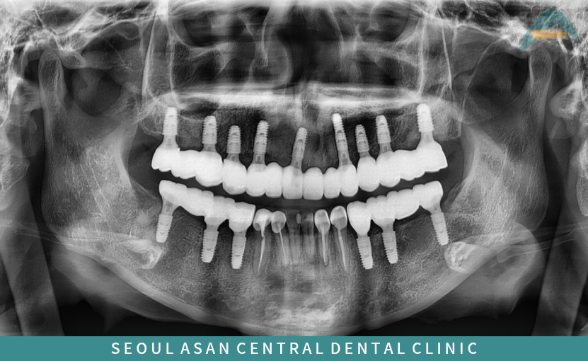 성남치과 전체임플란트 치료 후 파노라마