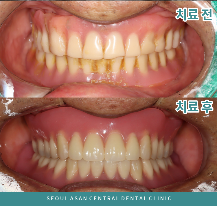 성남치과 틀니 치료는 개인의 구강 구조와 잇몸뼈 상태, 전신 건강 상태 등에 따라 적용 방법과 결과가 달라질 수 있어 충분한 정보 확인이 중요합니다.