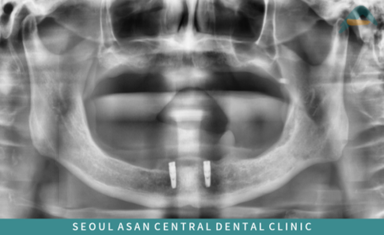 오버덴쳐란 쉽게 말해 임플란트와 틀니가 결합한 치과 보철물로 임플란트 틀니라고도 합니다.