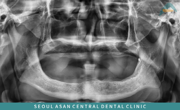 개인의 구강 상태와 잔존골 조건에 따라 적용 여부가 달라질 수 있어 성남치과에서는 충분한 상담과 정밀한 진단이 진행된다