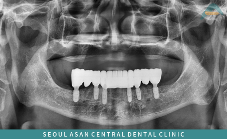 성남치과 치아 발치 후 임플란트 식립 후 파노라마 사진