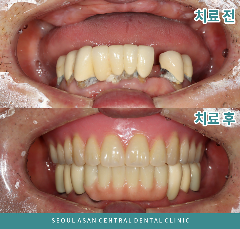 성남치과 임플란트와 틀니 치료 전후 구강 내 사진