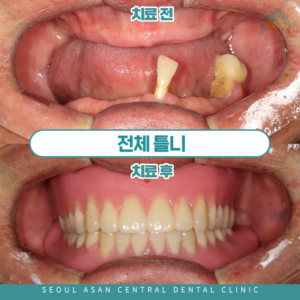 수정구치과 전체틀니