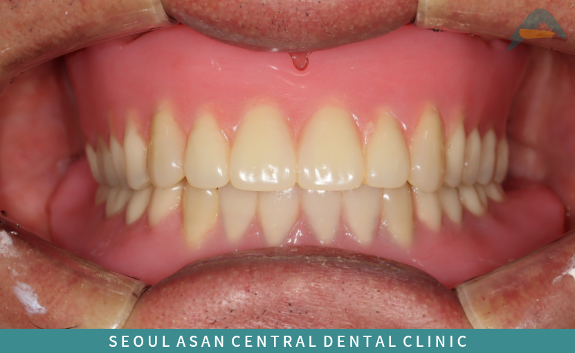 서울아산센트럴치과 틀니 치료가 끝나 모습