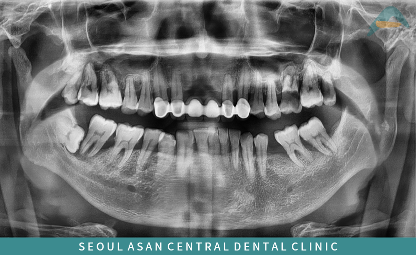 치료 전 파노라마 사진