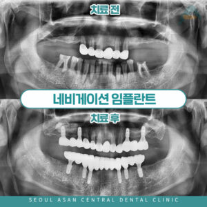 성남임플란트사후관리