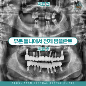 은행동수면임플란트